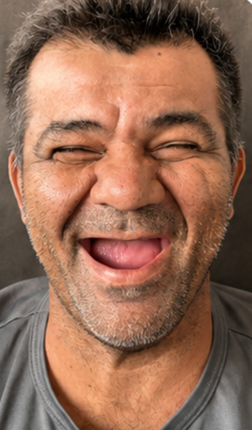 Paciente antes do tratamento com implantes dentários