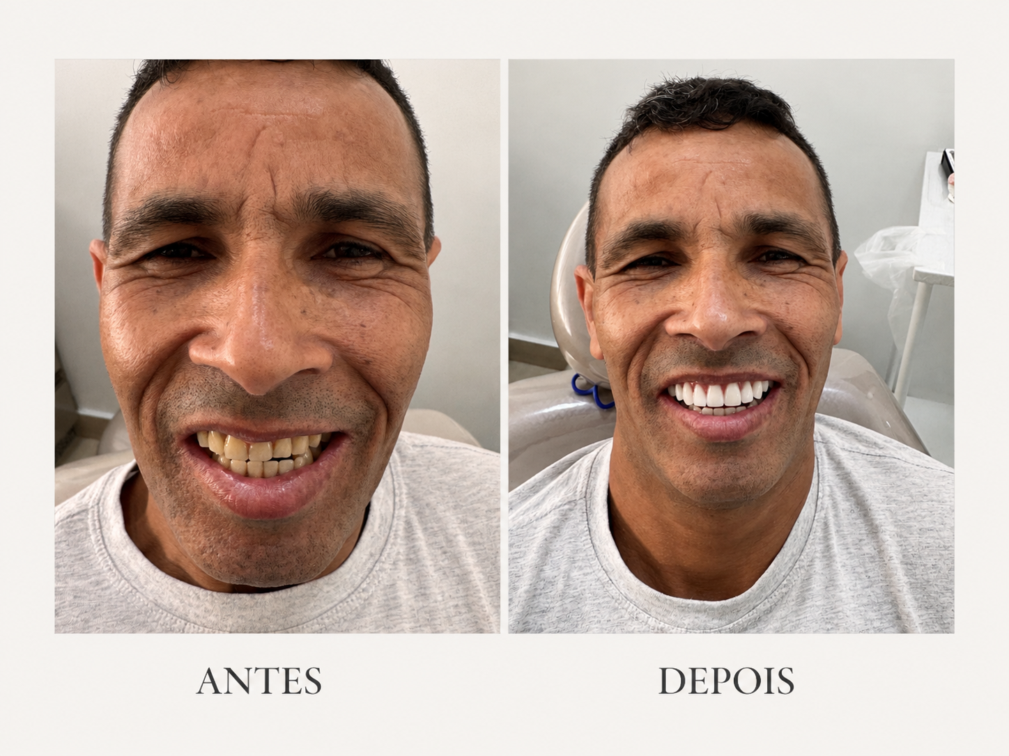 Antes e depois de reabilitação com implantes dentários — caso 1