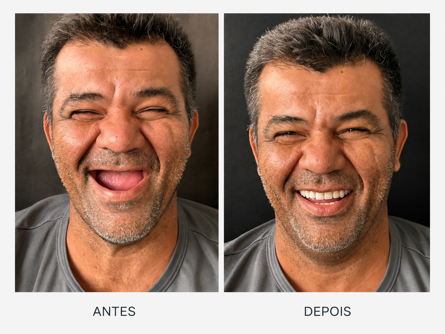 Antes e depois de reabilitação com implantes dentários — caso 2